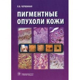 Пигментные опухоли кожи