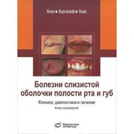 Болезни слизистой оболочки полости рта и губ. Клиника, диагностика и лечение